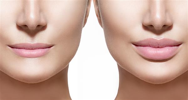قبل و بعد از تزریق فیلر لب پرکننده ها بزرگ کردن لب Beautiful Perfect Lips دهان از نزدیک لب زن جوان زیبا از نزدیک روی پس زمینه سفید
