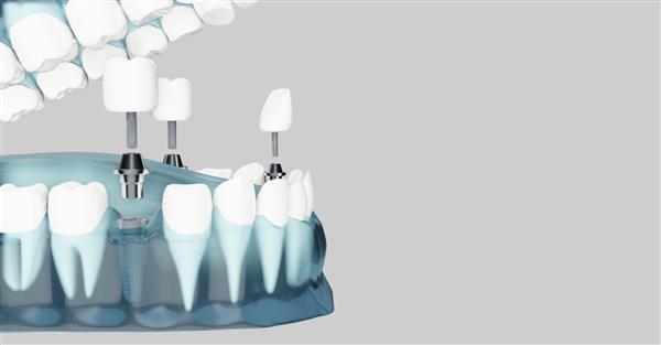 جزء ایمپلنت های دندانی و فضای کپی رنگ آبی شفاف تصویرسازی سه بعدی رندر سه بعدی
