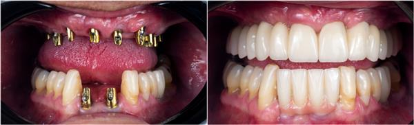 تصاویر قبل و بعد از ایمپلنت های دندانی و روکش های پرس سرامی