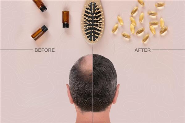 پوستر دیواری کاشت مو برای آقایان با طراحی زیبا و زمینه کرم