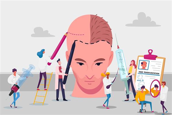 پوستر دیواری تخصصی کاشت مو با طراحی جذاب مراحل کاشت