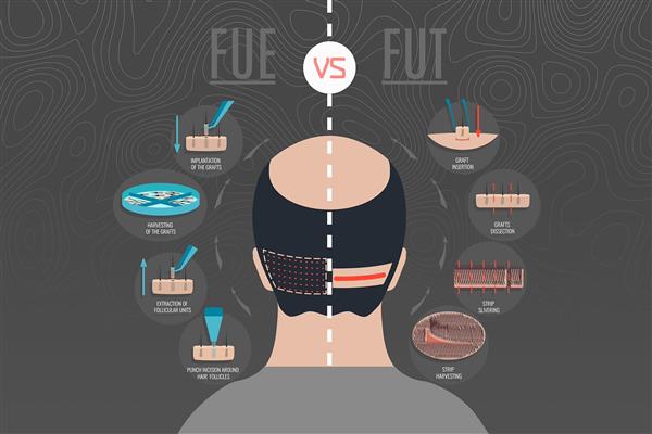 پوستر دیواری کلینیک کاشت مو با اینفو گرافی و توضیحات کامل